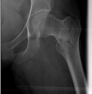 Hip Displaced Intertrochanteric Fracture